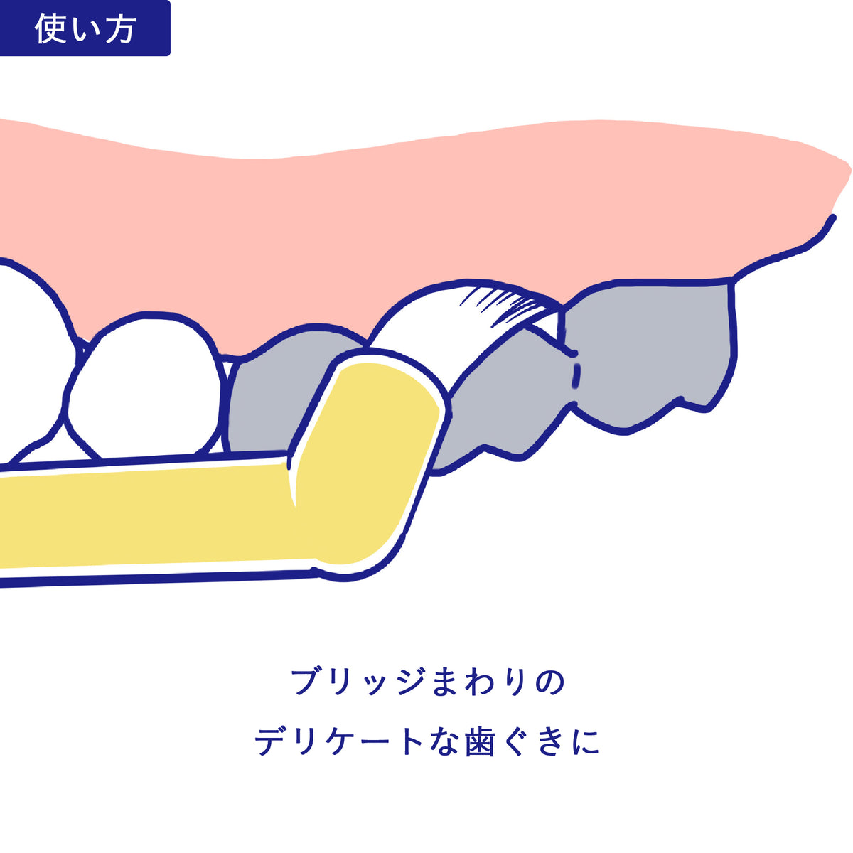 インプロ（ワンタフトブラシ） - Oral-Health Navi